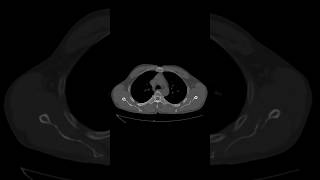 Comminuted displaced fracture of blade of the left scapula. #ctchest