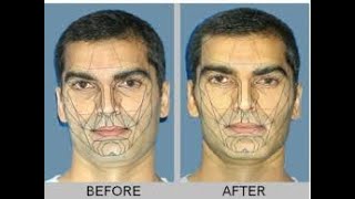 How to Correct Facial Asymmetries and Gummy Smile with DNA and Homeoblock Appliances