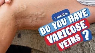 Do You Have Varicose Veins? (60 second health check)👨‍⚕️🩺