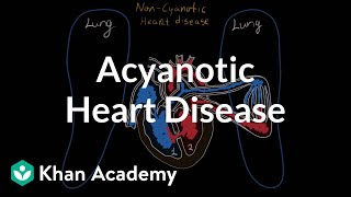 What is acyanotic heart disease? | Circulatory System and Disease | NCLEX-RN | Khan Academy