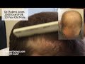 dr. robert jones 3500 graft fue 33 year old male