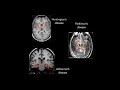 Genetics and Pathogenesis of Amyotrophic Lateral Sclerosis & Frontotemporal Dementia