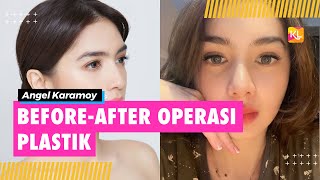 Before After Angel Karamoy Setelah Lakukan Operasi Plastik, Masih Merasa Belum Sempurna