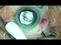 aioc 2023 gp174 topic dr krishnendu nandi iatrogenic tear in macular hole edge