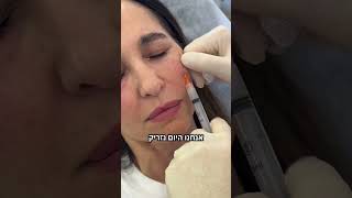 ד״ר אולג שפירו - טיפול לשיפור קמטוטים עדינים סביב העיניים באמצעות הזרקה של ביוסטימולטורים עדינים!