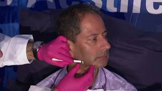 Treating the Submental Region: Facial Markings