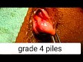 grade 4 piles | excision of piles | Ferguson hemmorhoidectomy | removal of piles | #dr #youtube