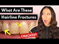 What are CRAZE LINES on Teeth & What to Do About Them