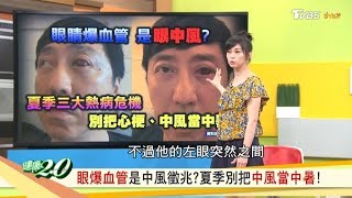 眼爆血管是中風徵兆？夏季別把中風當中暑！ 健康2.0 20190629 (完整版)