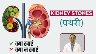 किडनी स्टोन में क्या खाएं और क्या ना खाएं | What Foods to Eat & Avoid to Prevent Kidney Stone