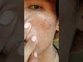 skincare beauty blackheads skincareroutine satisfying 115 song lyrics madskincare acne