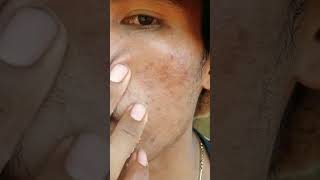 #skincare #beauty #blackheads #skincareroutine #satisfying #115 #song #lyrics #madskincare #acne