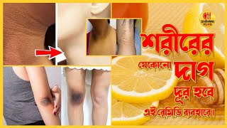 🔴(লাইভ রেজাল্ট ) কথা দিচ্ছি মাত্র ৫ মিনিটেই বগলের কালো দাগ দূর হবেই | Dark Underarms কে ফর্সা করুন