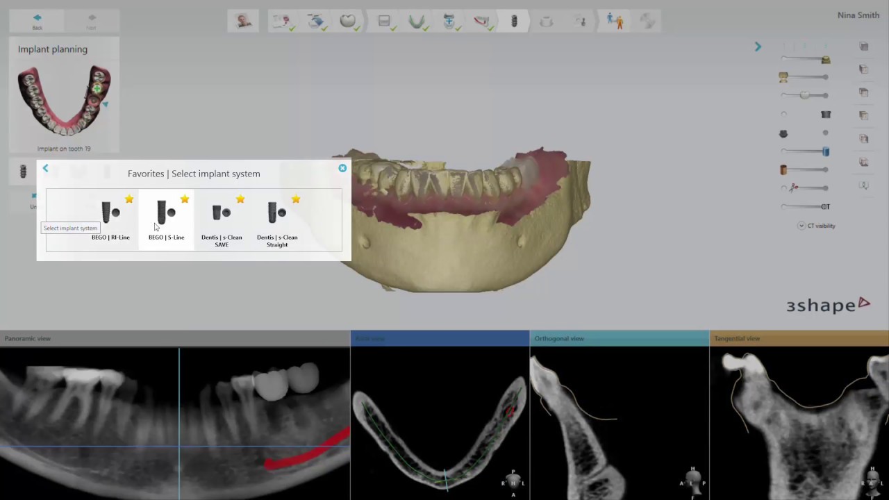 3Shape Implant Studio - Favorite Implant Libraries - YouTube