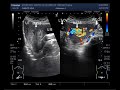 Ultrasound Video showing multiple cases of fibroids uterus.