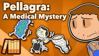 Pellagra - A Medical Mystery - Extra History