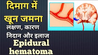 दिमाग में खून जमना (एपिड्यूरल हीमेटोमा) || Epidural hematoma explained in Hindi ||MedHealth support