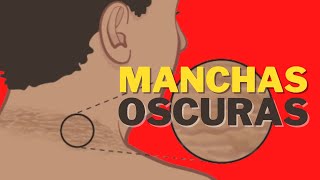 Que Significan las MANCHAS OSCURAS en el cuello |  Consultorio Médico  👩🏻‍⚕️