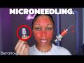 My Honest Seranova Micro Infusion Kit Review 💕 The Secret to Radiant Skin? ⭐️