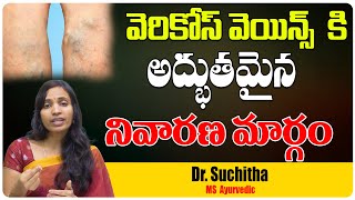 Varicose Veins Telugu | Ayurvedic Treatment | వేరికోస్ వీన్స్ | Varicose Veins Treatment|Health Tree