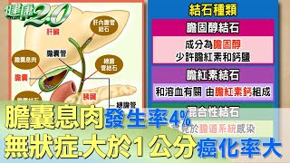 膽囊息肉發生率4% 無狀症.大於1公分癌化率大 健康2.0