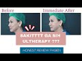 ULTHERAPY BEFORE AFTER for SKIN TIGHTENING - Ovela Clinic