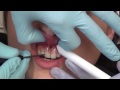 how to do a simple upper lip frenectomy with electrosurge. dental