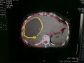 Pyogenic abscess of Liver | Findings of Liver on CT | Abdominal Scan | Liver plain CT Scan | Part 1