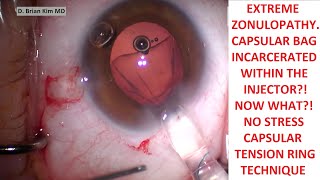 Extreme Zonulopathy. Capsular Bag Incarcerated in the Incision?! Now What? Capsule Tension Ring Tech