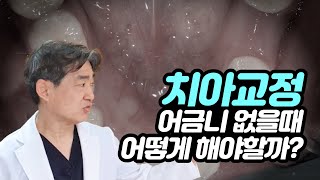 치아교정전에 꼭 확인해보세요!! 어금니 없을때 어떻게 해야 할까??