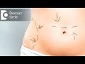 What is the downtime when one goes for a Mini Tummy Tuck? - Dr. Srikanth V