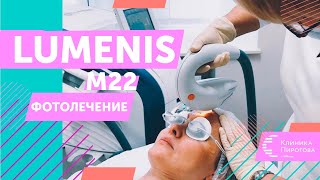 Убираем пигментные пятна на лице. Фотолечение кожи на аппарате M22 Lumenis