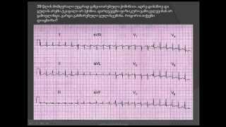 ეკგ / ფილტვის არტერიის თრომბოემბოლია (ფილტვის არტერიის ემბოლია) / filtvis arteriis tromboembolia