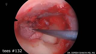 Endoscopic tympanoplasty with Ossiculoplasty