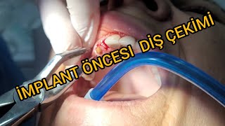 Implant Öncesi Diş Çekimi (Dişlerden biri Lezyonlu )