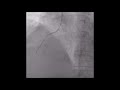 Guidezilla Catheter to deliver a stent in a tortuous RCA