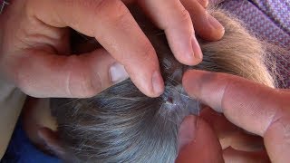 КАК вытащить КЛЕЩА с помощью БУТЫЛКИ How to remove a tick with a bottle