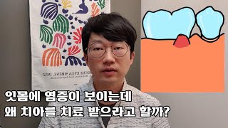 잇몸에 염증이 보이는데 왜 치아를 치료하라고 할까? 치아 기원 염증과 궤양