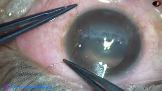 CORNEAL WOUND REPAIR by 10/0 nylon suture : Dr Pradip Mohanta, MS Ophth. 15th March, 2021