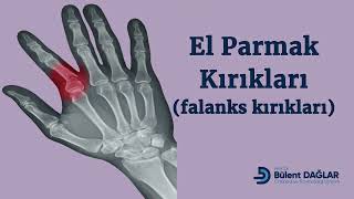 El Parmak (Falanks) Kırıkları