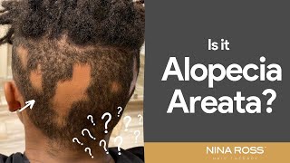 Is your hair loss Alopecia Areata? Watch this immediately and find out!