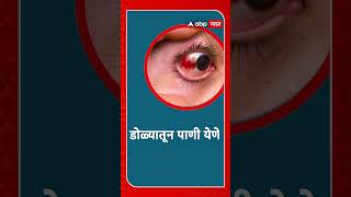 Eye Fule :  डोळे आल्यास काय काळजी घ्याल?