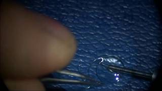 PMMA IOL vs Nitinol wire