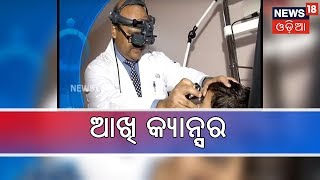 Eye Cancer in Children | ଆଖି ଭିତରେ ହେଉଥିବା କ୍ୟାନ୍ସର ବିଷୟରେ ଜାଣିରଖନ୍ତୁ