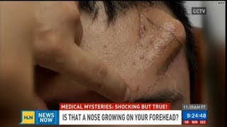 Why is this nose growing on man's forehead?