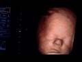 Medison x8 4D ultrasound Training Tutorial in Arabic Medison x8 4D ultrasound Training Tutorial in Arabic