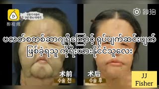 ပလတ်စတစ်ဆာဂျရီကြောင့် ဘဝပျက်ခဲ့ရသူမိန်းကလေး