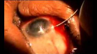 Cataract Eye Surgery