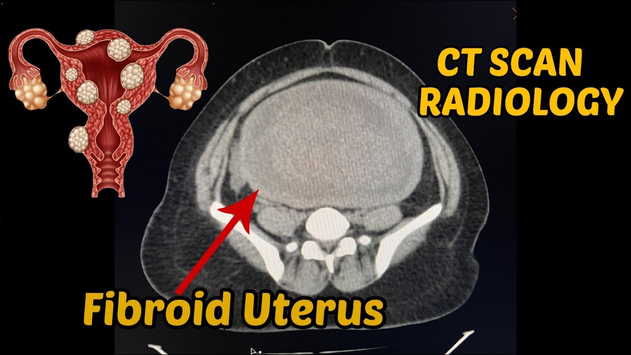 Uterine Fibroid | Diagnosis | Ct Scan | Radiology | - YouTube