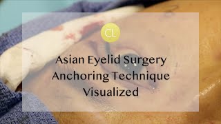 #ChaseLayMD Asian Eyelid Surgery: Anchoring Technique Visualized